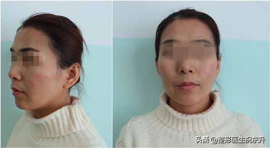 什么脸不适合做脂肪全脸填充,全脸脂肪填充的哪些部位自然