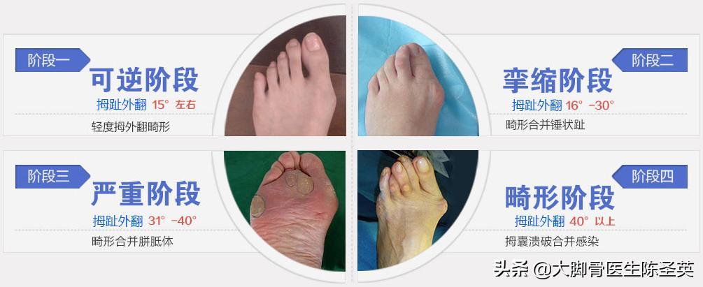 结婚时新娘发鞋给亲朋有哪些规定,接亲找鞋是什么习俗