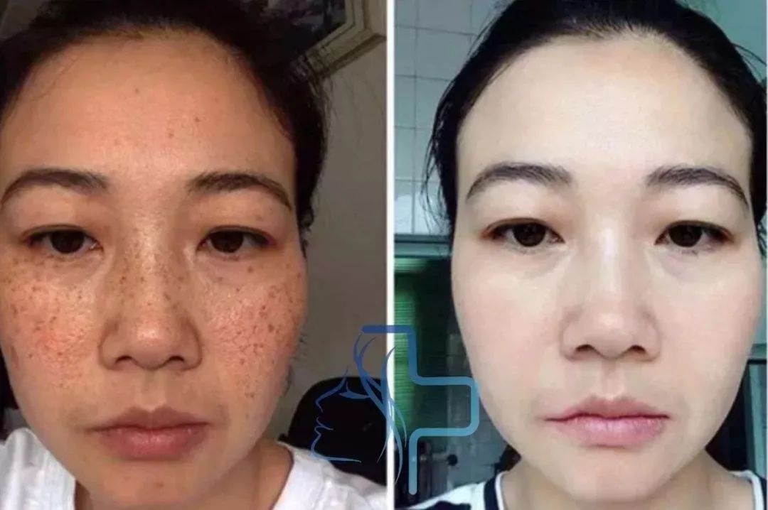 美白祛黄提亮肤色泡水喝,每天喝一杯可以美白淡斑清热解毒