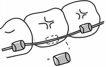 牙套的最后一个托槽掉落要紧吗,为什么牙套托槽那么容易掉