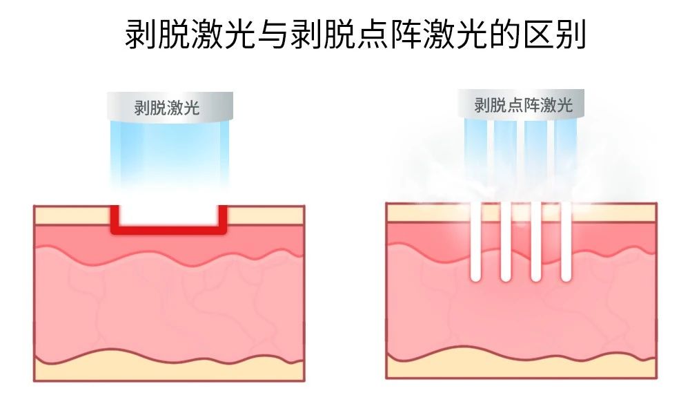 沈阳点阵激光除痘坑做得好,痘坑打点阵激光多少岁能做