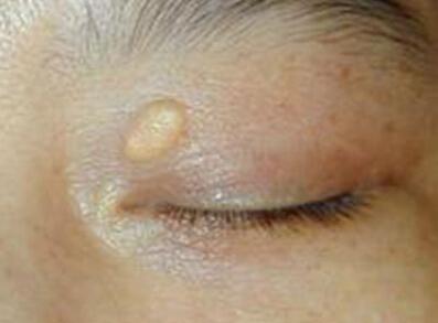 眼睛角长了个睑黄瘤是什么东西,眼睑附近长的淡黄色的睑黄瘤