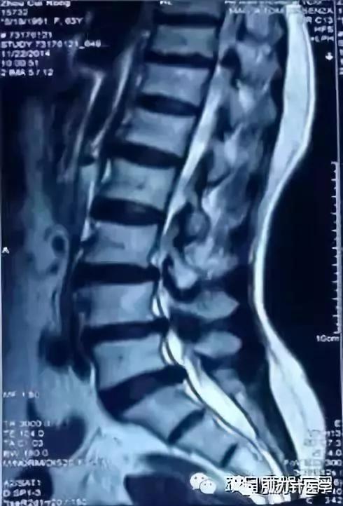 王学昌谈腰椎管狭窄,王学昌治疗神经根型颈椎病视频