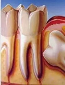 智齿牙齿烂了一半到底要不要拔掉,牙科小知识哪些智齿该拔除