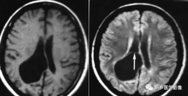 脑室为什么会扩张,脑室为什么会变小