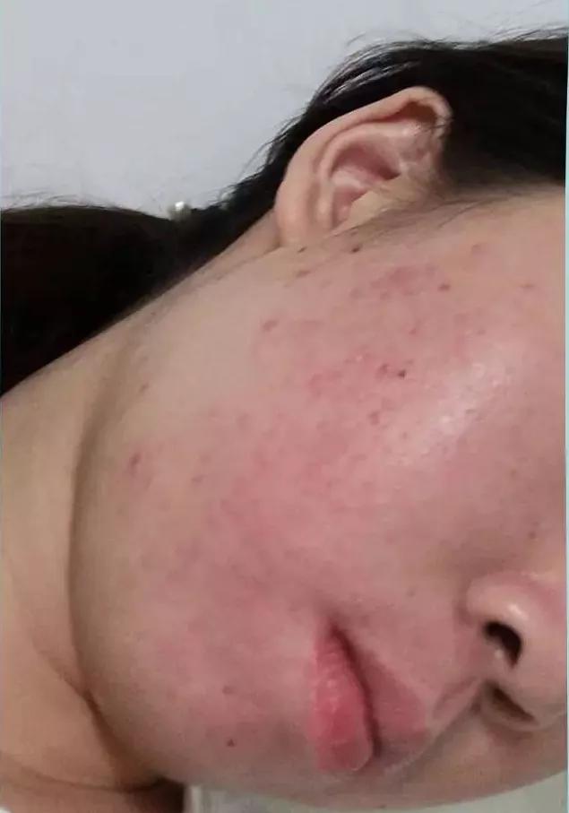 治痘痘维a酸类药膏哪个好,异维a酸胶囊可以永久治好痘痘吗