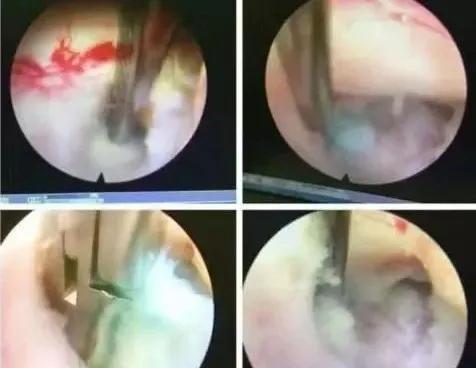 成功开展“钥匙孔”技术治疗颈椎病