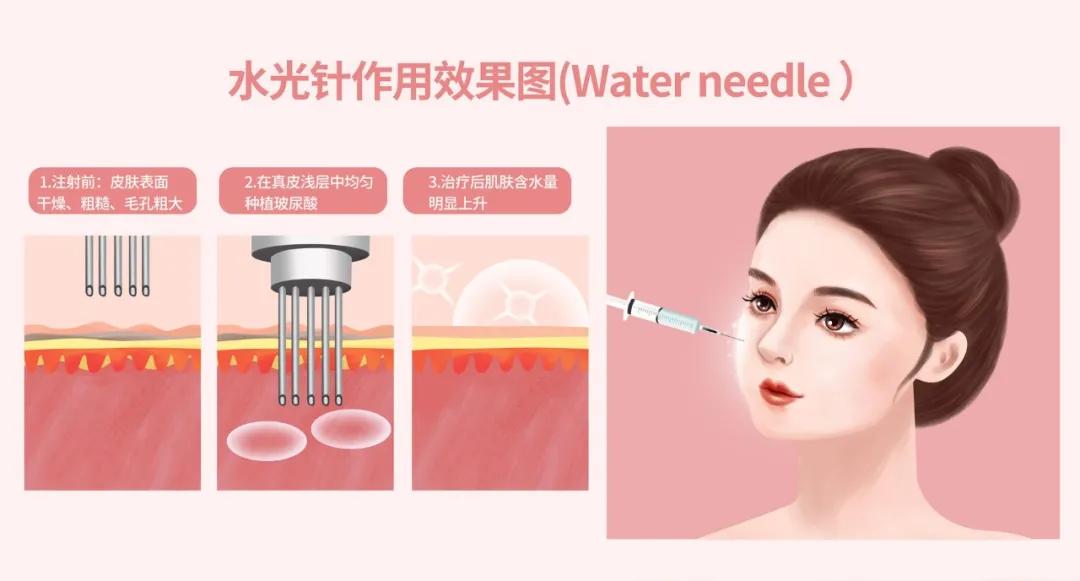 医生科普光子水光针,水光针专业知识分享