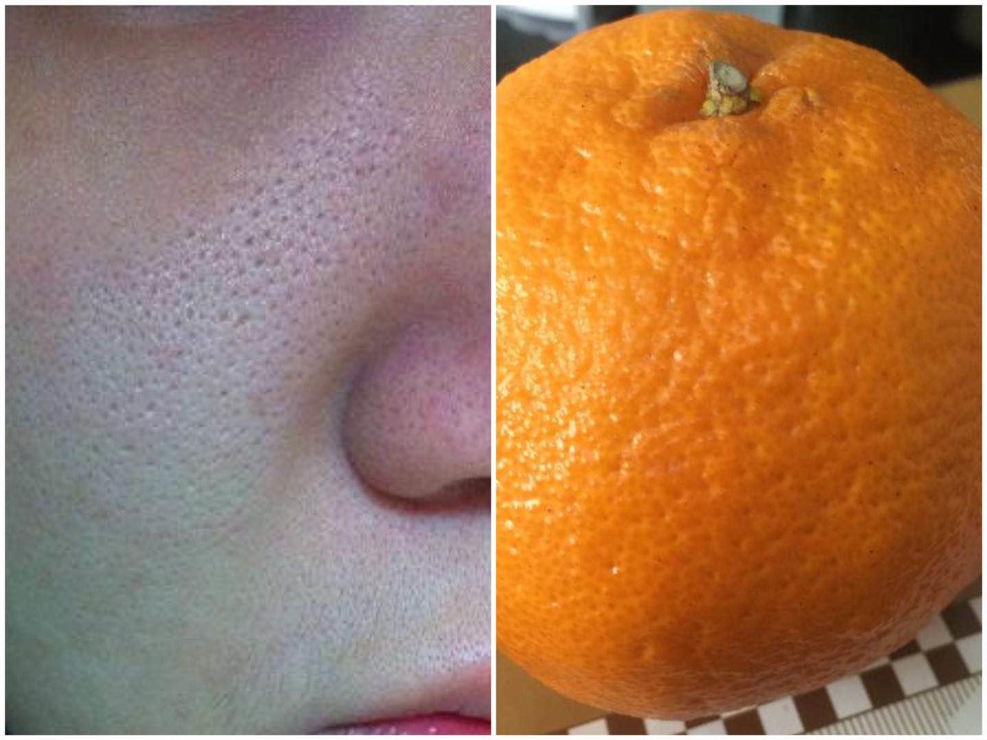 女生最怕“1孔1黑”,特别影响颜值,很多人女生中招还不自知