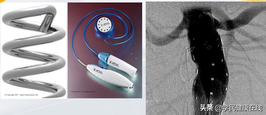 腹主动脉瘤术后内瘘怎么办,腹主动脉瘤出现内瘘解决办法