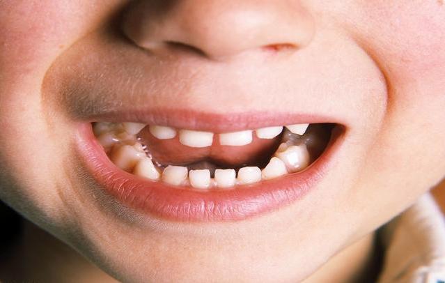 宝宝乳牙稀疏换牙后会好吗,乳牙长得很稀疏换牙会好看点吗