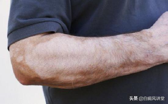 无色素痣白斑毛发会变白吗,腋窝有白斑毛发变白什么原因