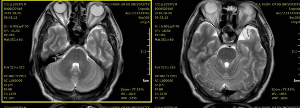 颈内动脉c3段动脉瘤是什么症状,右颈内动脉c3段动脉瘤是什么意思