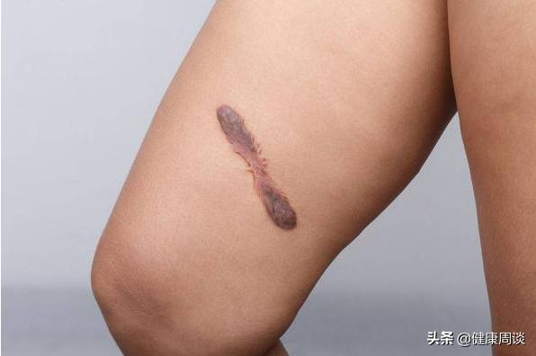 留下黑色疤痕会癌变吗,疤痕癌变的最佳治疗方法