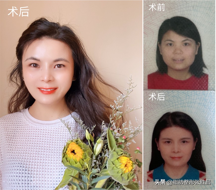 脂肪填充第二天的感受,下巴脂肪填充真实感受