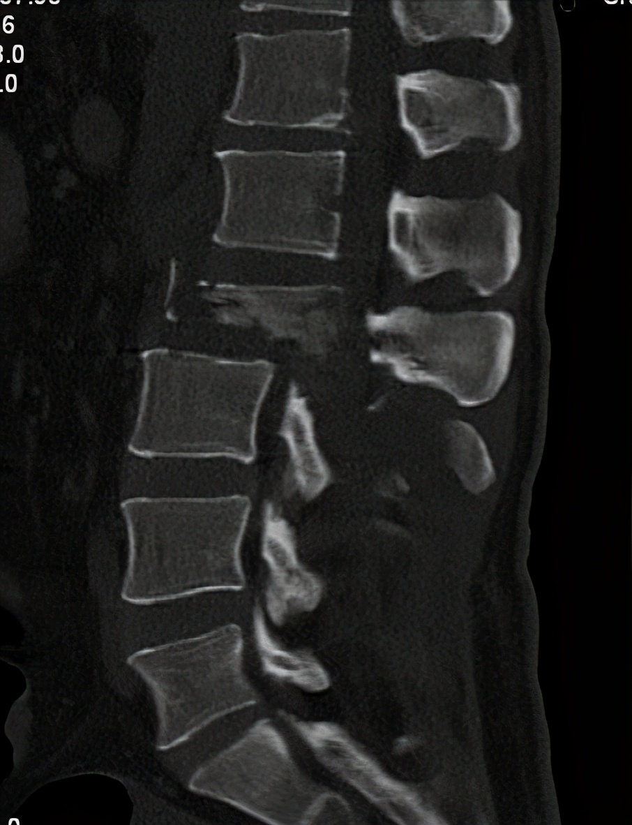 从瘫痪到重新站起来,瘫痪后重新站起来的有吗