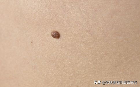 脸上有色斑应该怎么调理,脸上斑越来越多原因及治疗方法