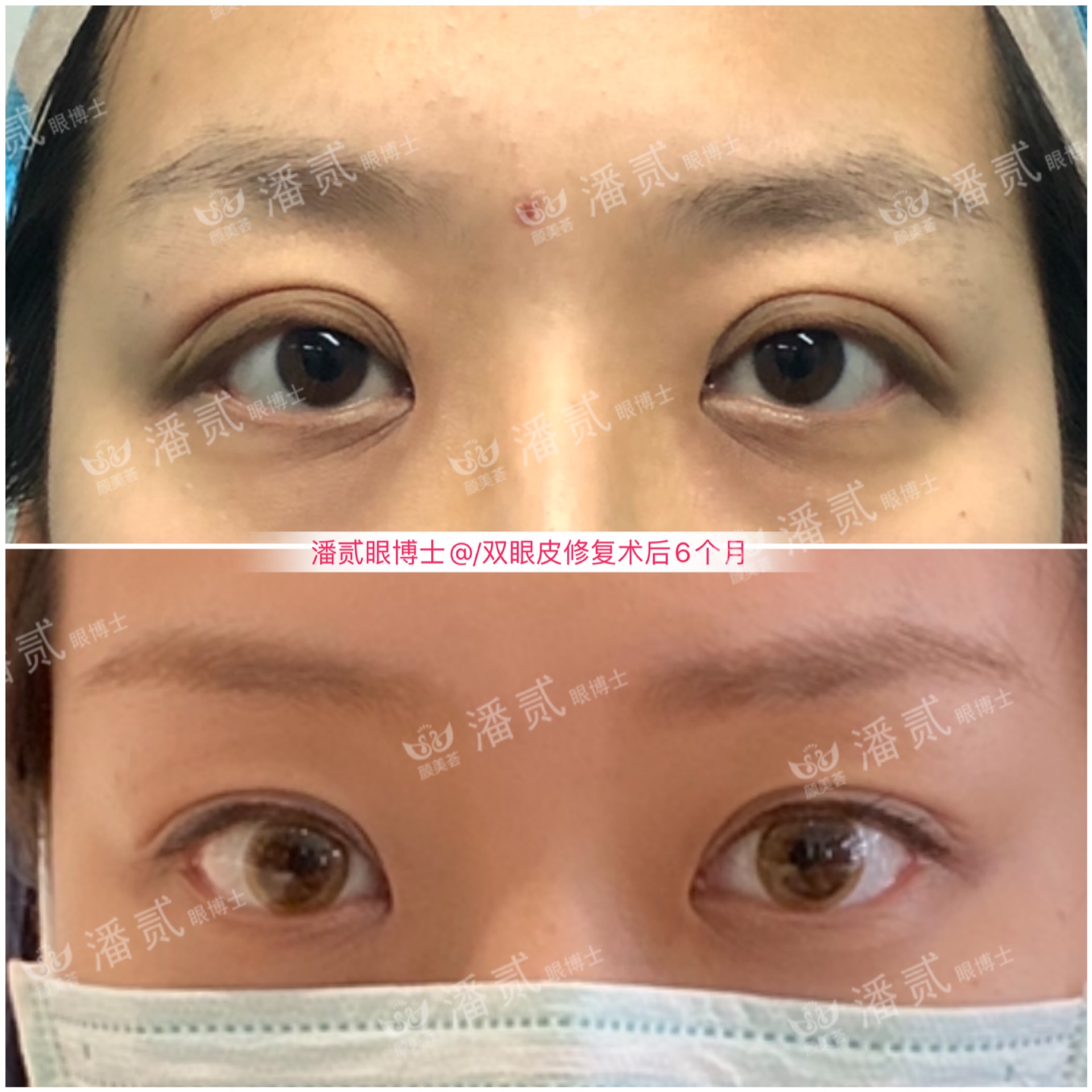 双眼皮失败的女孩,双眼皮失败做成了三眼皮好修复吗