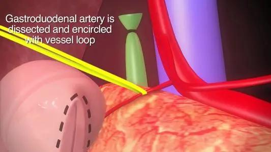 自体胰岛素移植能治愈糖尿病吗,胰腺干细胞移植和胰岛移植