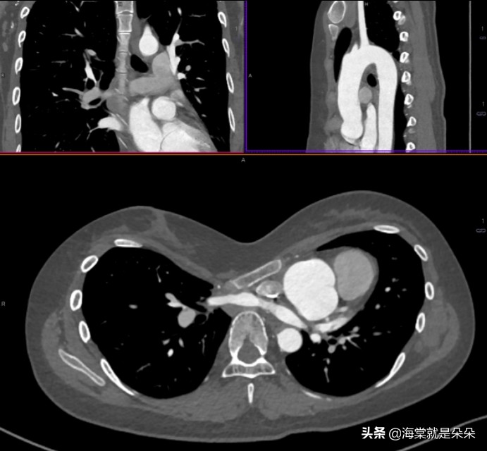 先天漏斗胸跟心脏不好有关吗,成年人漏斗胸压迫心脏