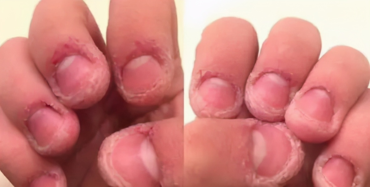 抠手、啃指甲停不下来，这些习惯要注意