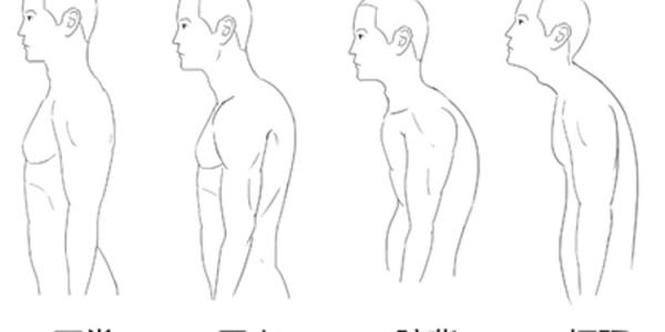 骨科大夫教你改善驼背,驼背的人如何矫正脊椎弯曲
