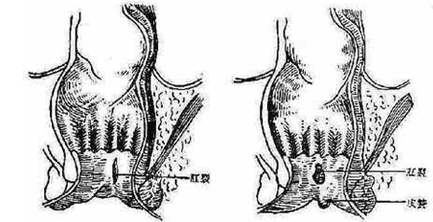 肛裂手术后痊愈的症状,肛裂有痒的症状怎么治
