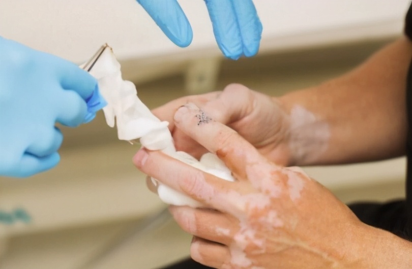 白癜风吃药治疗后为何变白,白癜风用药40天变化不大怎么办