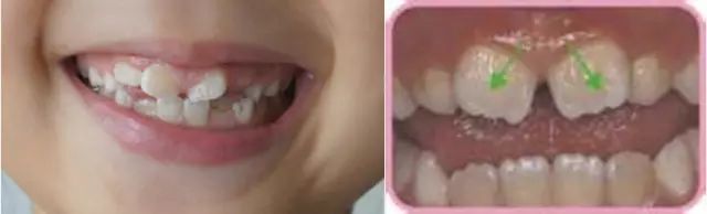 孩子多余的牙齿什么年龄适合拔掉,小孩子的牙齿需要填补吗