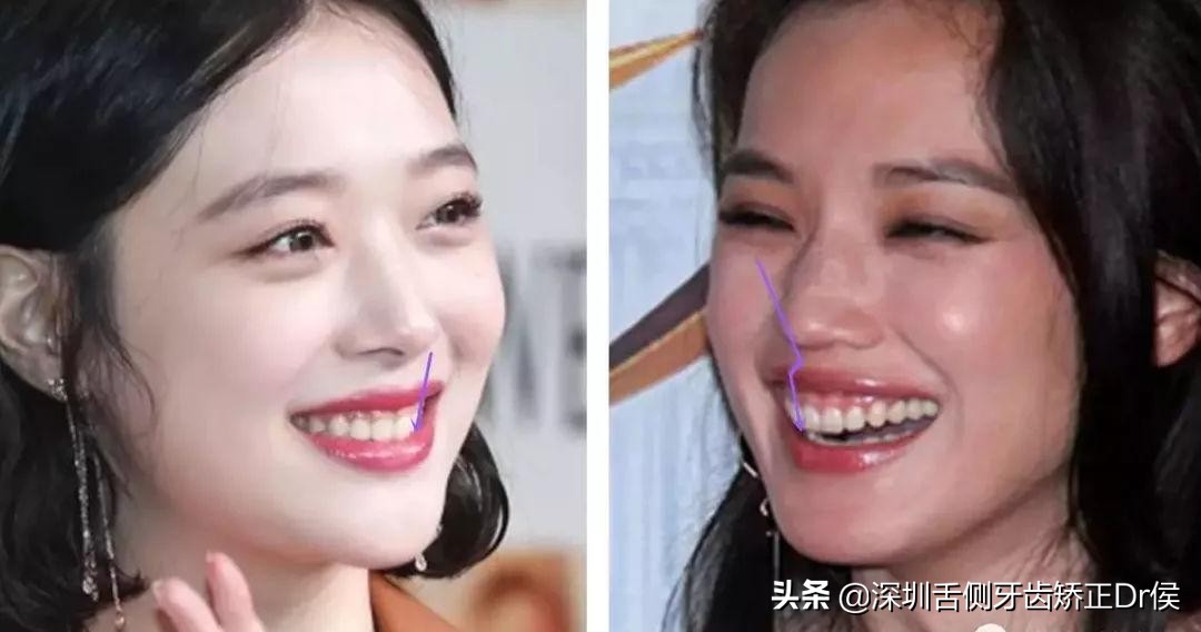 露龈笑原因,露龈笑矫正