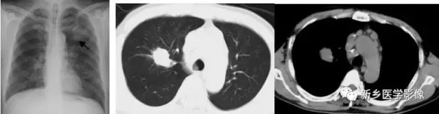 肺部基础免疫,肺基础疾病有哪些