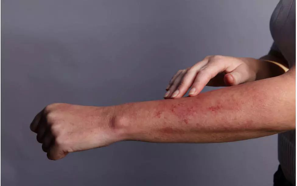 针灸异常情况处理视频讲座,针灸异常情况处理ppt