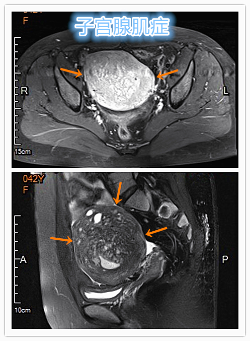 从手上扎针插管就能治子宫腺肌症——经桡动脉入路子宫动脉栓塞术