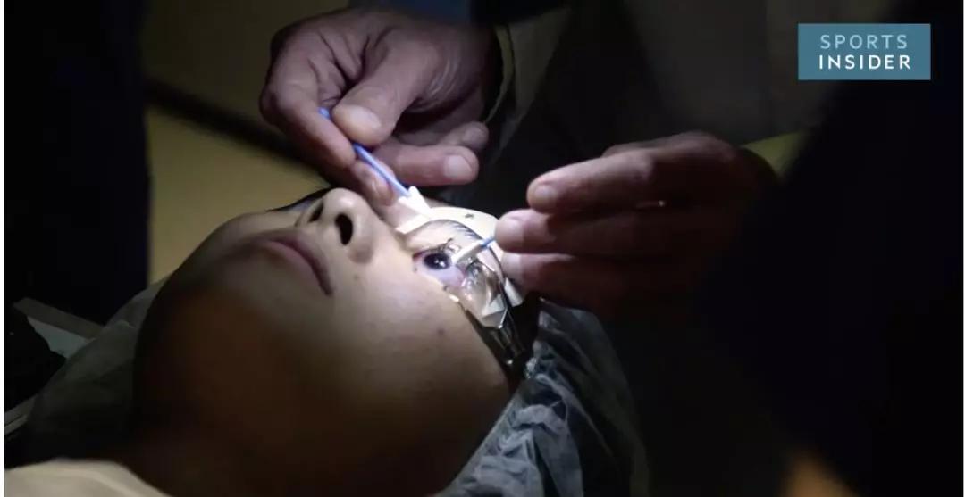 做眼科激光手术的不良反应,做激光眼科手术有后遗症么