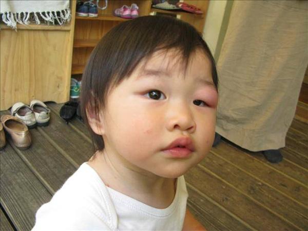 孩子被咬后，若呈现这些状况代表不是蚊子咬的包，别自行处理