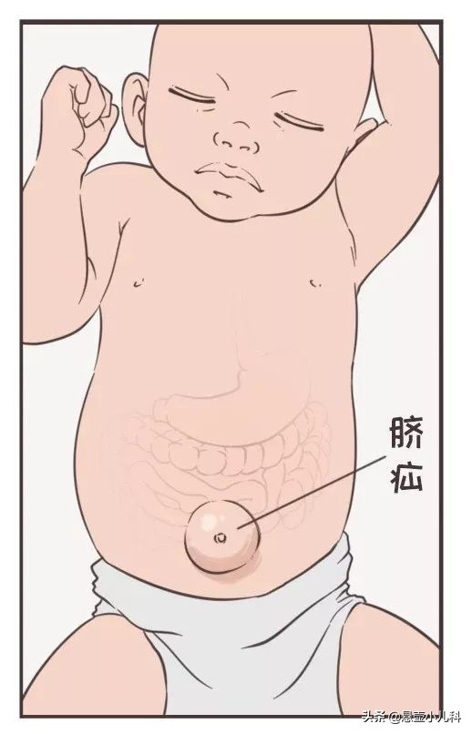 婴儿大脐疝可以自愈吗,婴儿脐疝自愈的小妙招