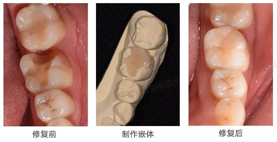 牙齿楔状缺损修复图片,牙齿楔状缺损修复大概多少钱