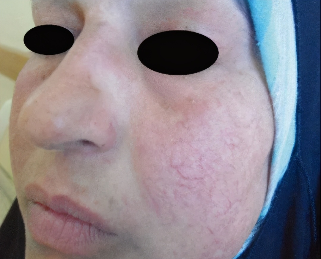 华山皮肤科激素依赖性皮炎,皮肤病激素依赖性皮炎怎么治疗