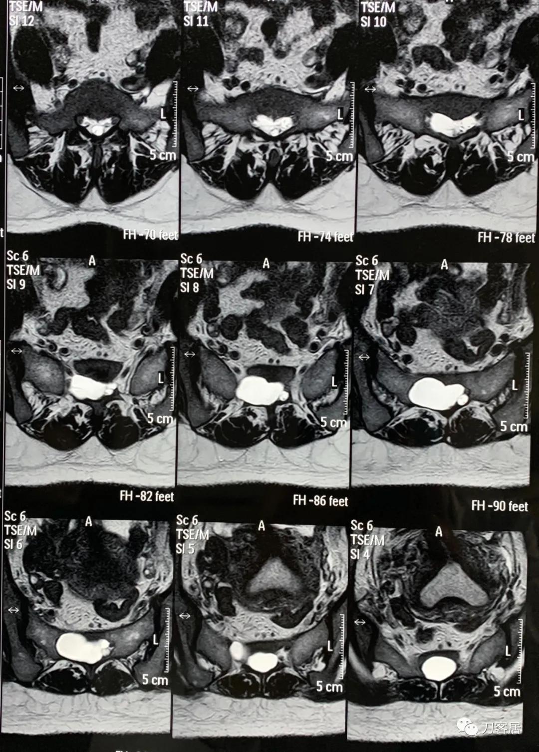 髋关节骶管囊肿,骶管囊肿手术后右腿还是疼咋回事