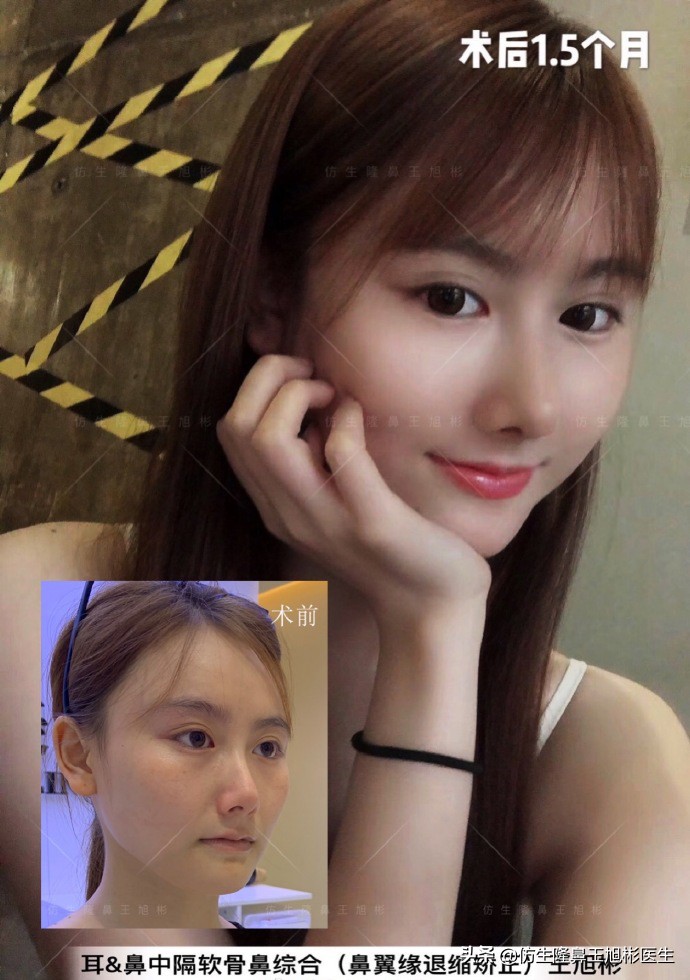 王旭彬:朝天鼻、露鼻孔,模特菲菲短鼻矫正手术后1.5个月