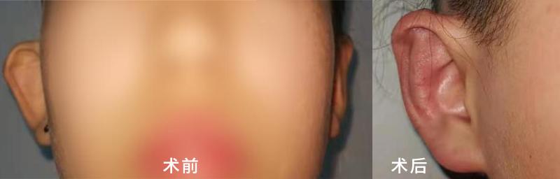 耳廓受压导致招风耳可以调整吗,招风耳是畸形耳吗怎么治疗