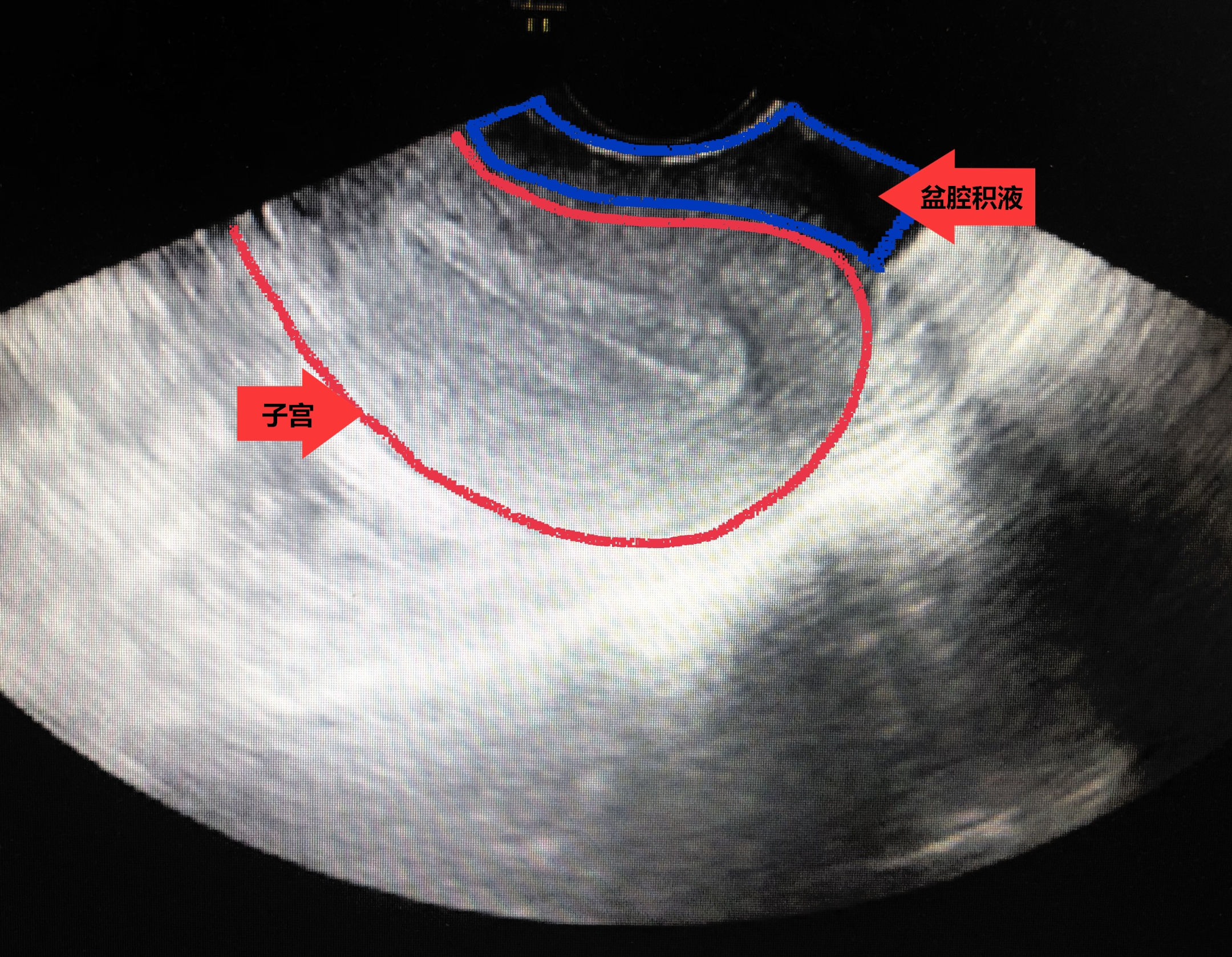 盆腔积液中医怎么治疗,中医怎么治疗盆腔积液