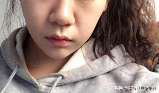 法令纹松弛脸颊下垂怎么填充,用什么来填充法令纹是最好的