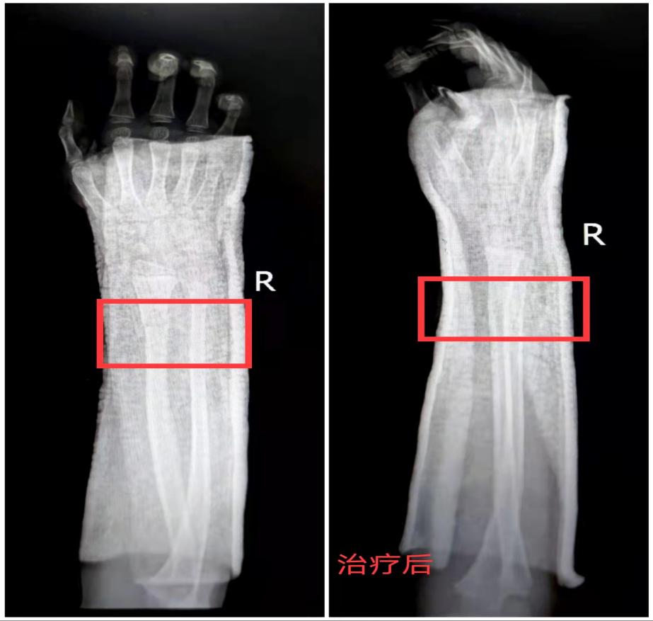 孩子意外骨折如何处理,3岁女童受伤医生建议报警