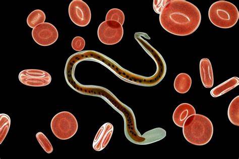 丝虫病大象腿后续,丝虫病在腿上