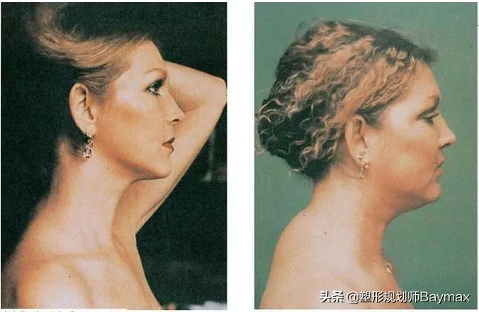 为什么背有富贵包,背很厚有富贵包怎么解决