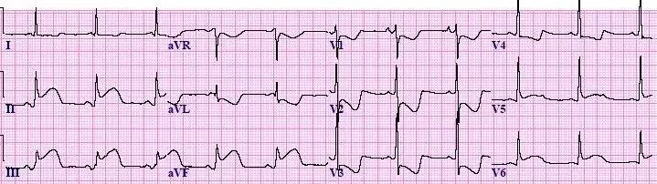 常见心梗特殊心电图,各部位心梗心电图详解