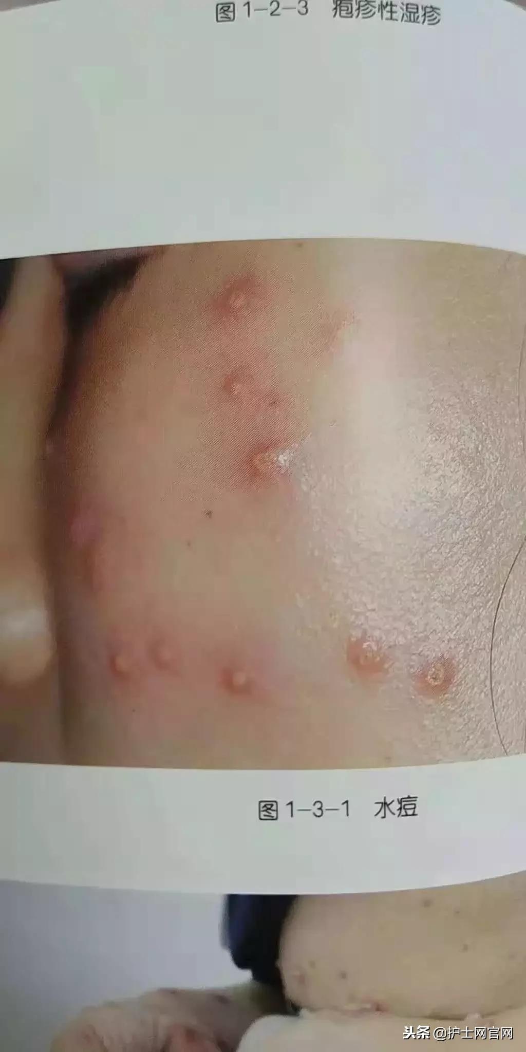 水痘患者怎么隔离,水痘病人病室挂什么隔离