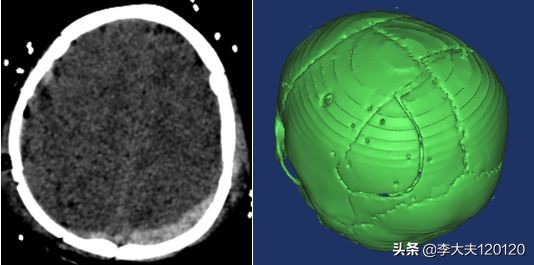 孩子额头被东西砸伤怎么处理,儿童头部摔伤后该如何做应急处理
