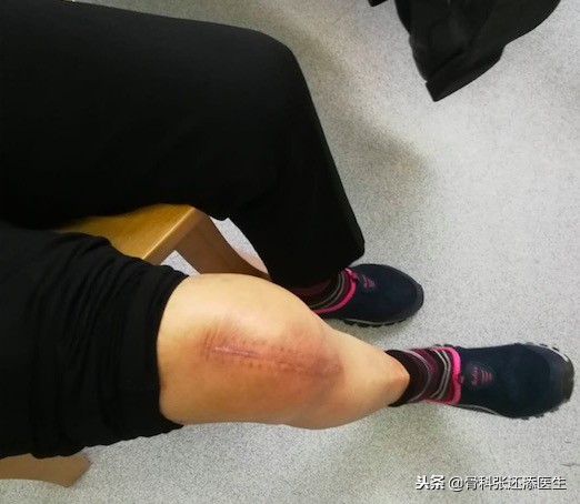 膝关节疼痛贴药贴贴在什么位置,关节疼痛贴膝盖贴管用吗